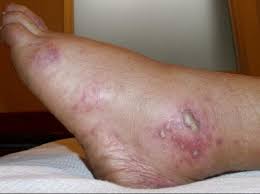 Ateneo Fiebre por mordedura de rata